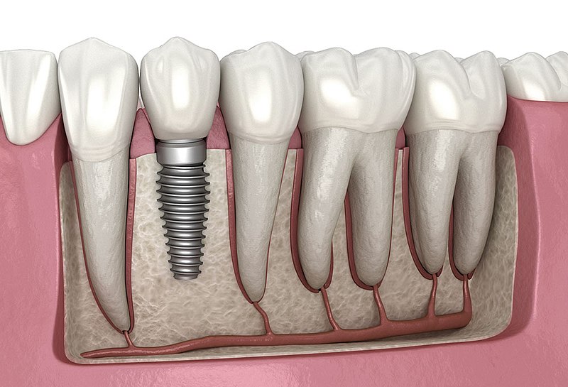 Why do dental implants fell out?