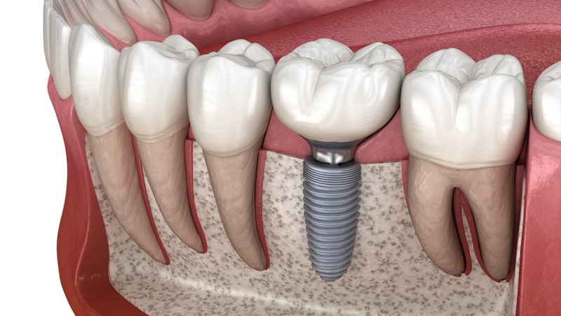 Why are dental implants infected?