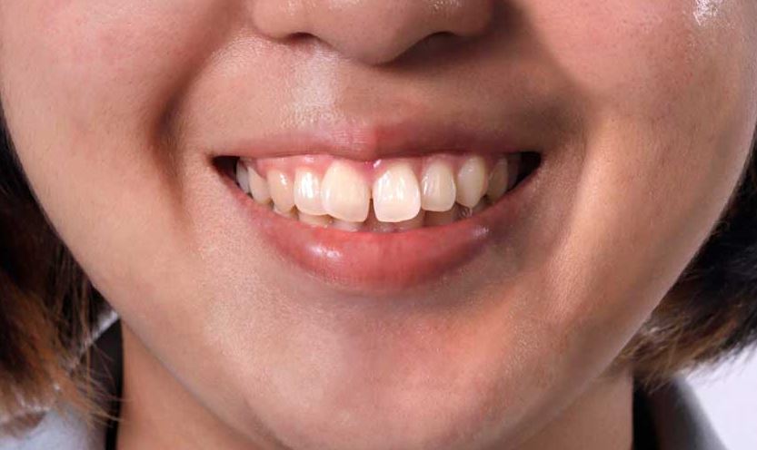 Những hậu quả do răng hô gây nên