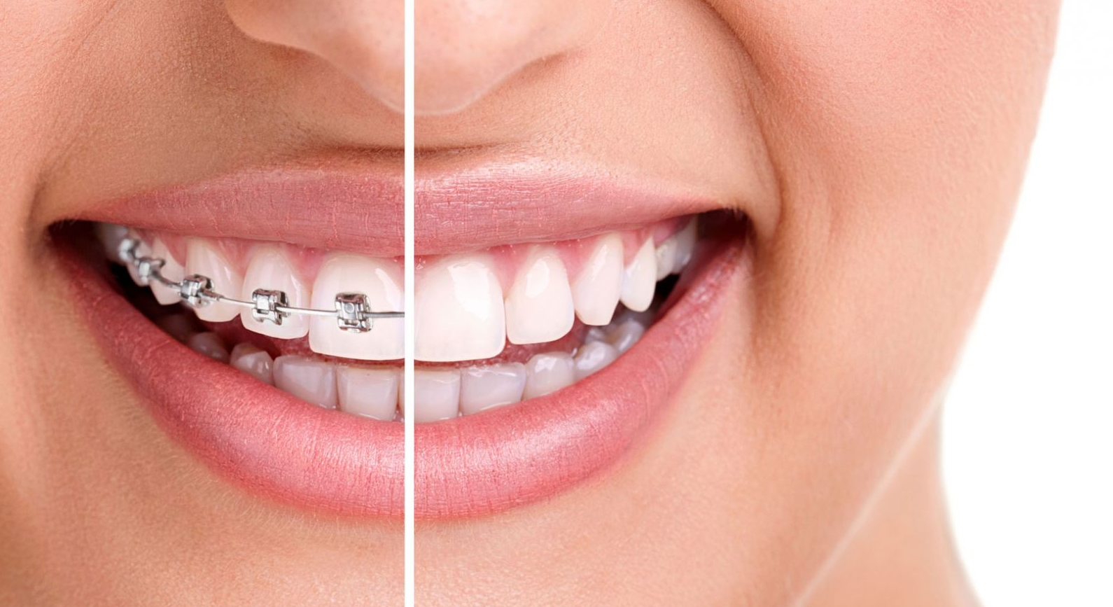 Khi nào cần niềng răng, khi nào nên bọc sứ