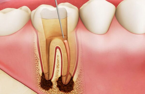 Lấy tủy bọc răng sứ giá bao nhiêu?