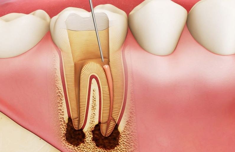 Lấy tủy bọc răng sứ giá bao nhiêu?