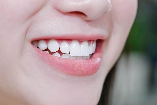 Lợi ích của lấy tủy bọc răng sứ
