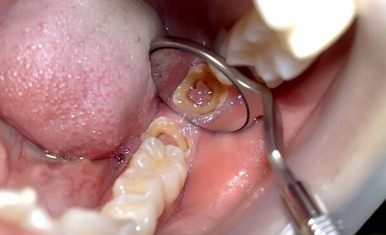 Một số trường hợp buộc phải lấy tủy răng