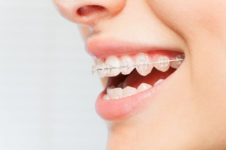 Nhược điểm của niềng răng mắc cài trong suốt