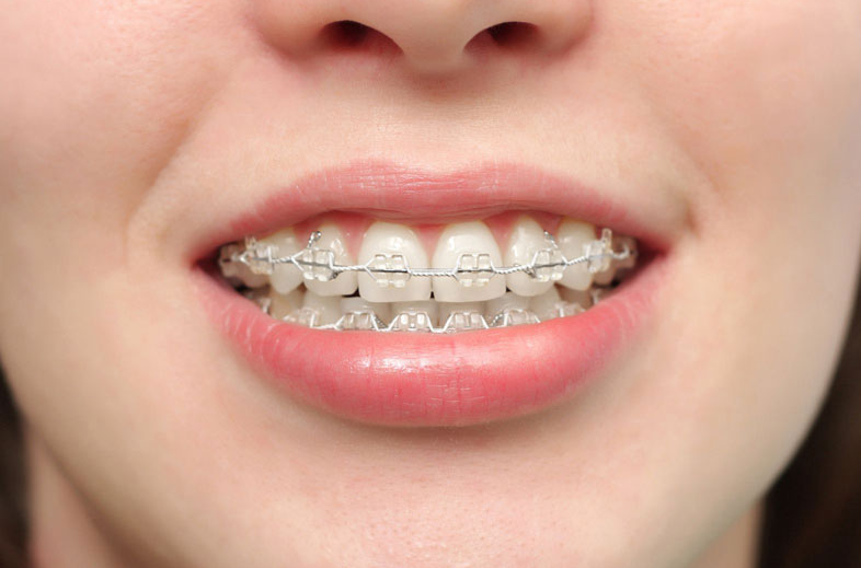 Niềng răng có ảnh hưởng đến thần kinh không