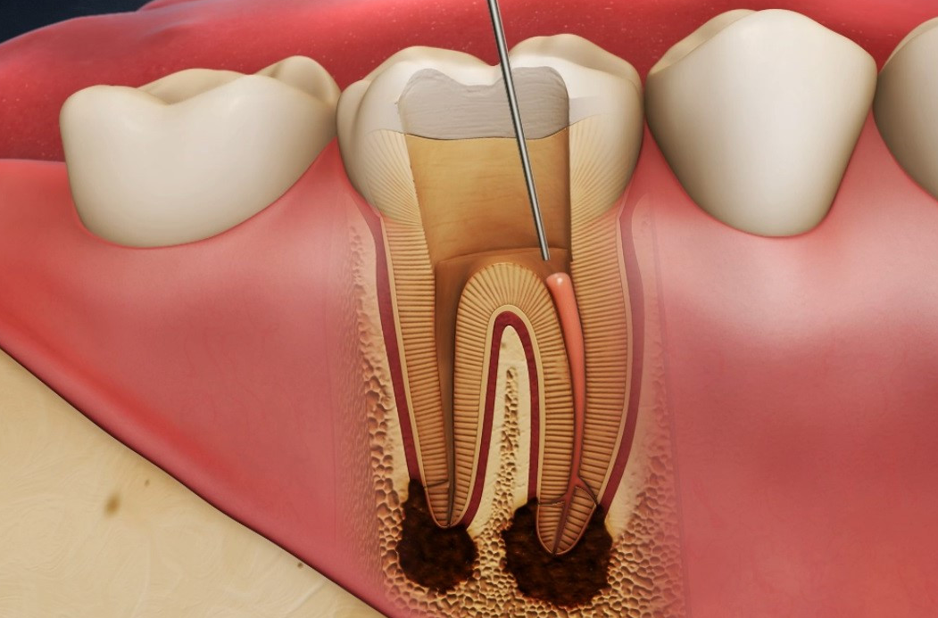 Răng bị chết tủy 