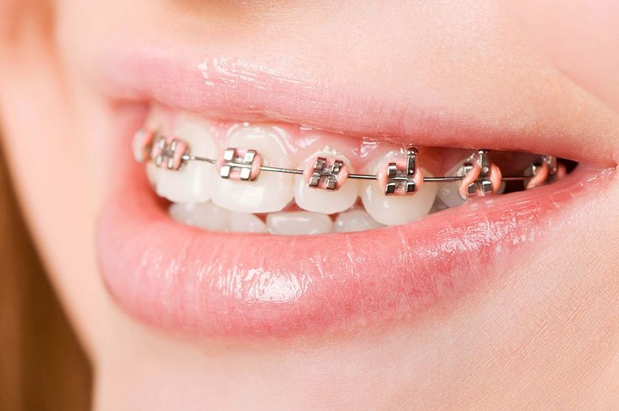 Niềng răng hô mất bao lâu?