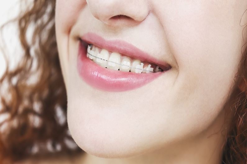 Niềng răng mắc cài trong suốt