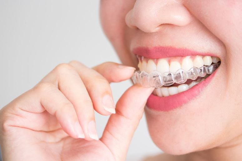 niềng răng trong suốt Invisalign