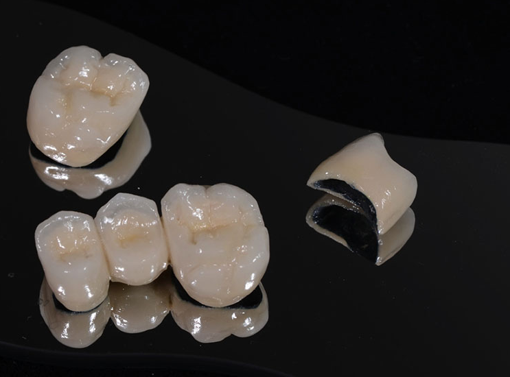Ưu điểm của răng sứ Titan