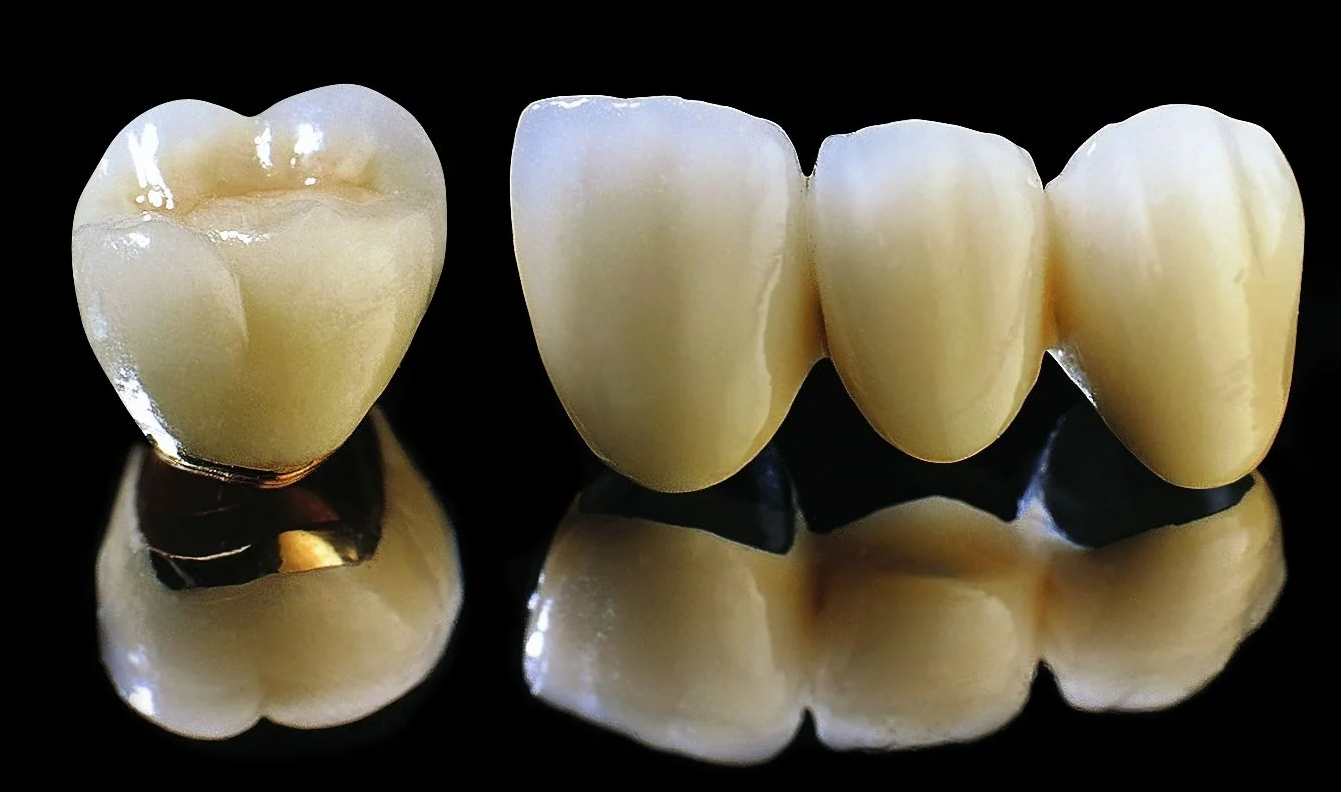 răng sứ Titan giá bao nhiêu tiền