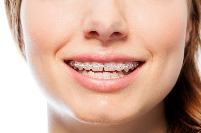 Thời gian niềng răng mắc cài trong suốt