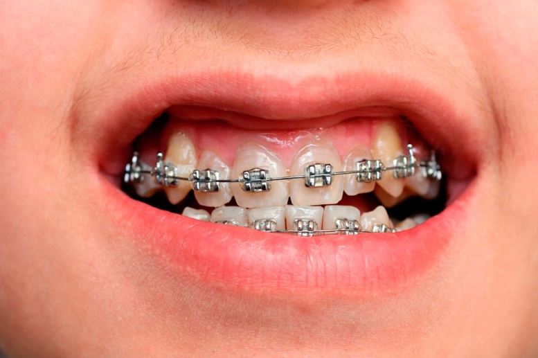 niềng răng mắc cài
