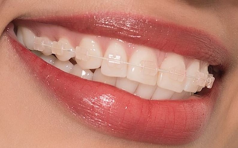 Ưu điểm của niềng răng mắc cài trong suốt