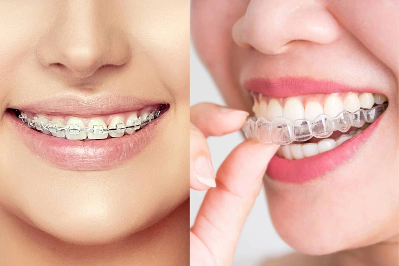 Vài cách phòng ngừa các biến chứng niềng răng bị lệch mặt