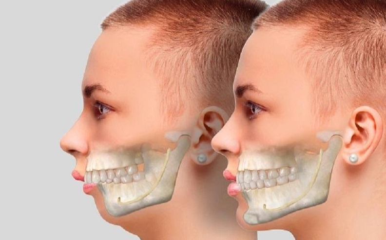 Răng bị hô, vẩu, khấp khểnh