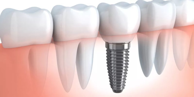 How to care for your dental implants during the healing period?
