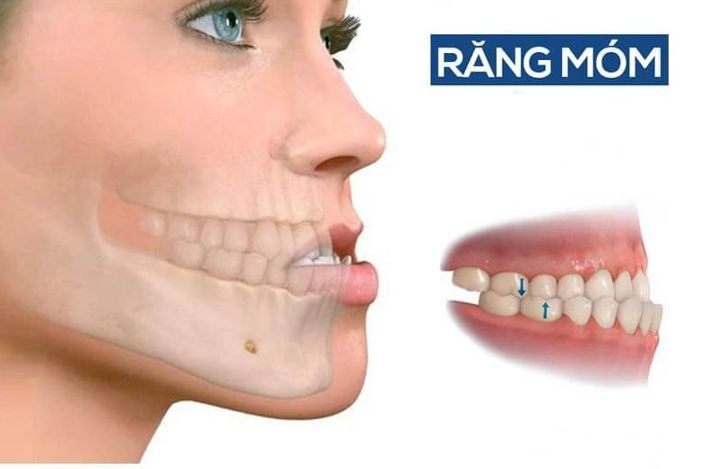 Khớp cắn ngược là gì