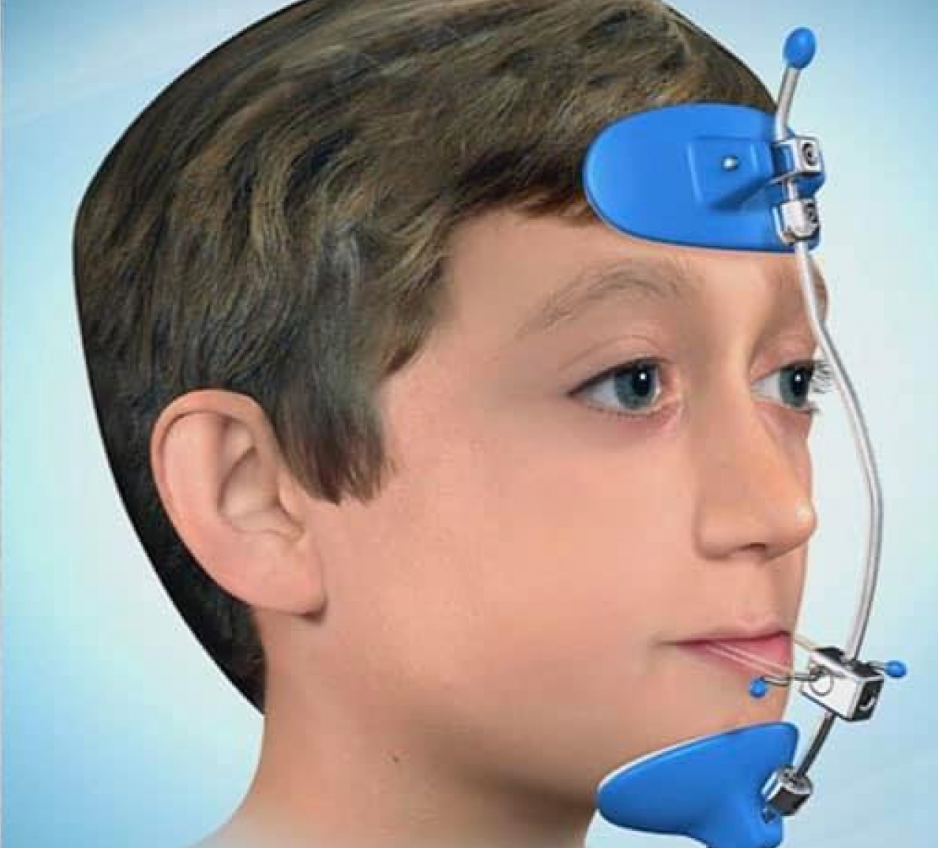Các dạng khớp cắn ngược thường gặp