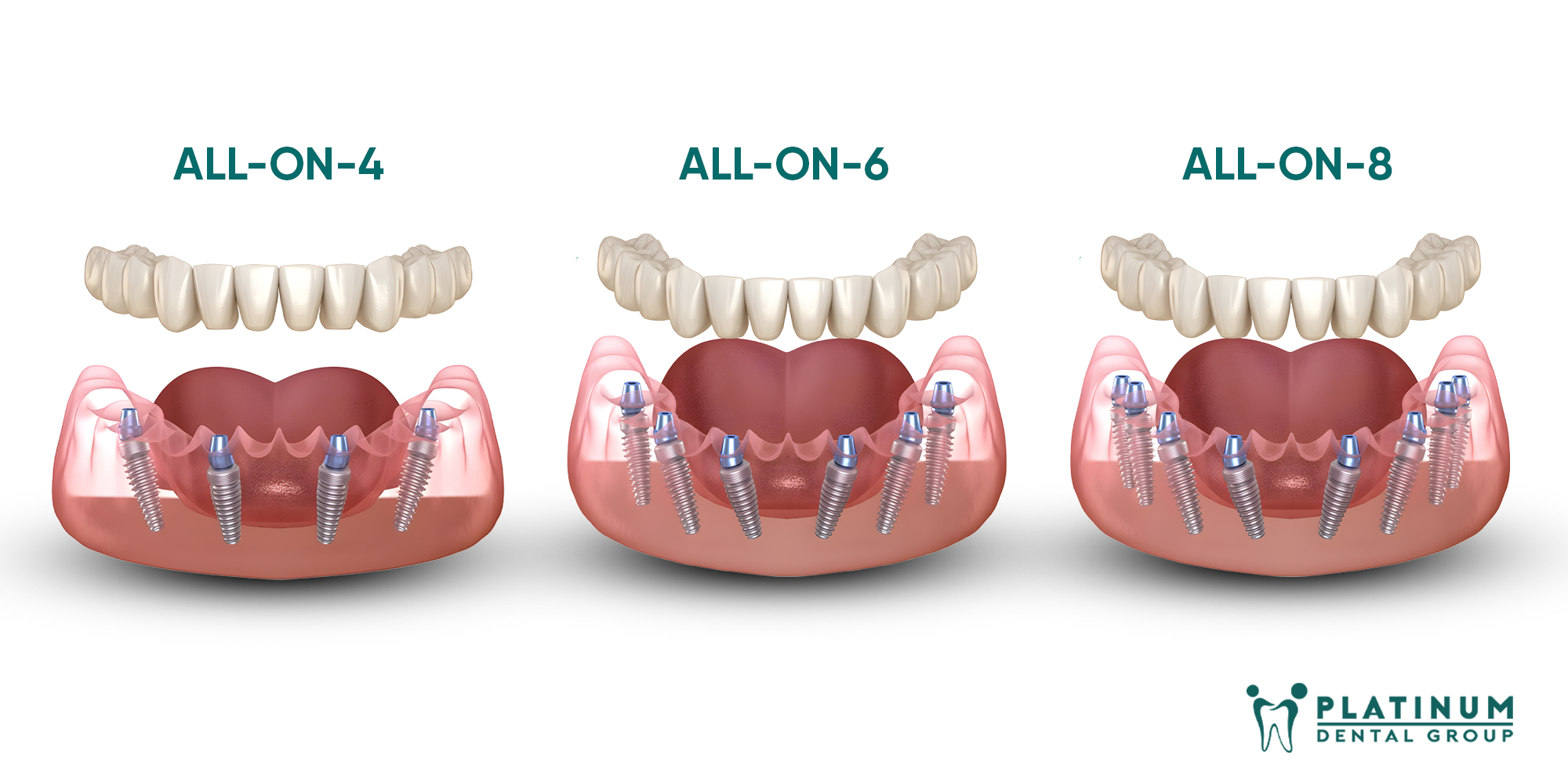 giá trồng răng implant