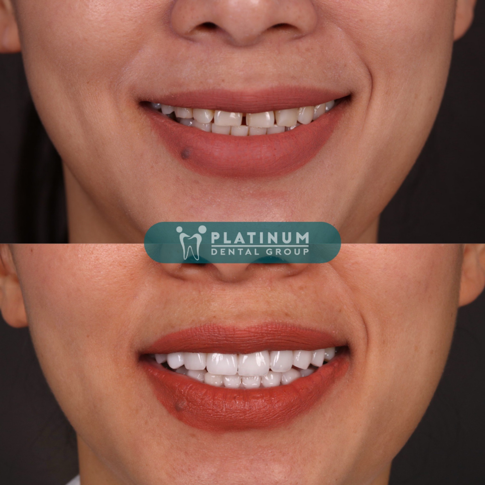 Hình ảnh trước và sau khi dán sứ Veneer tại Platinum Dental