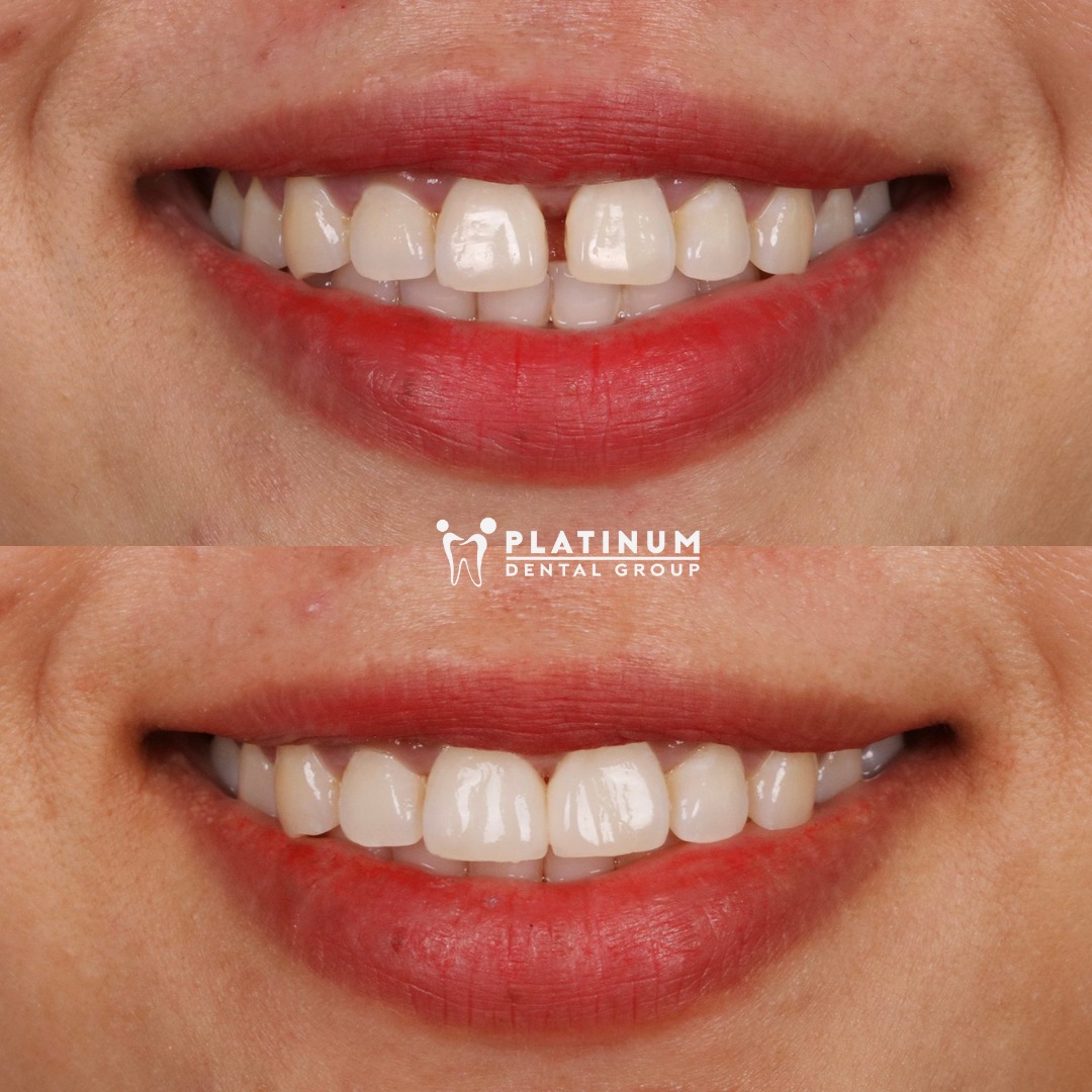 Hình ảnh trước và sau khi dán sứ Veneer tại Platinum Dental
