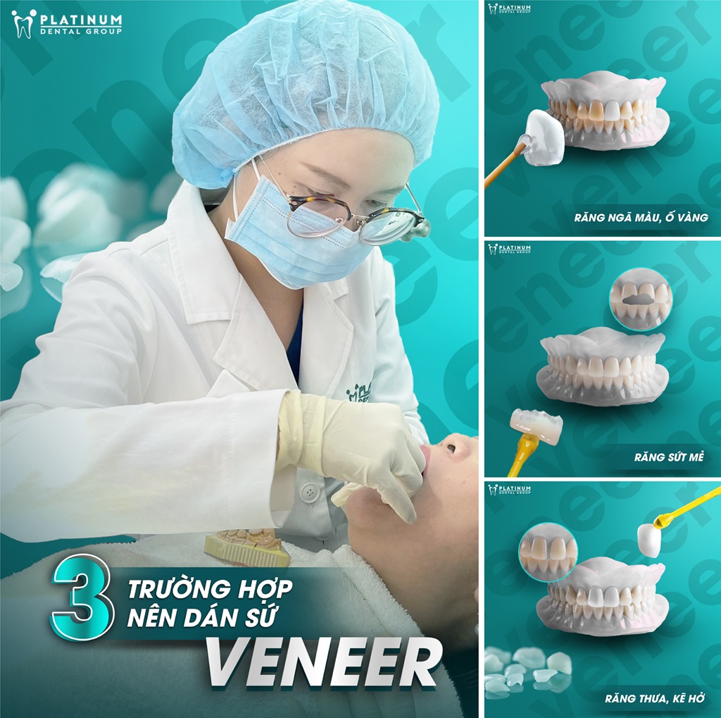 Gắn thật lần 2 và chỉnh khớp 