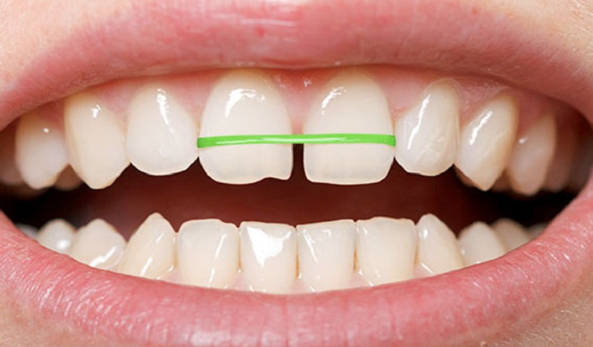 Niềng răng bằng dây thun