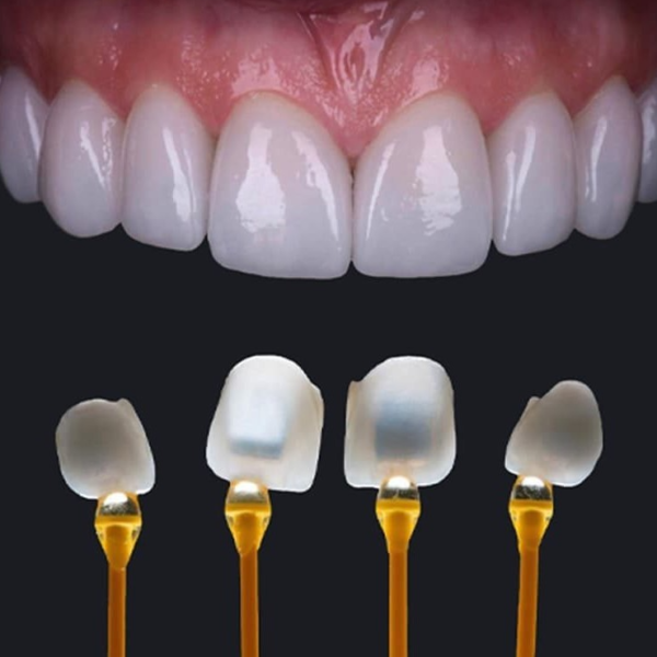 bảng giá dán sứ Veneer