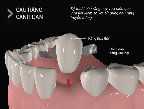 Cầu răng cánh dán