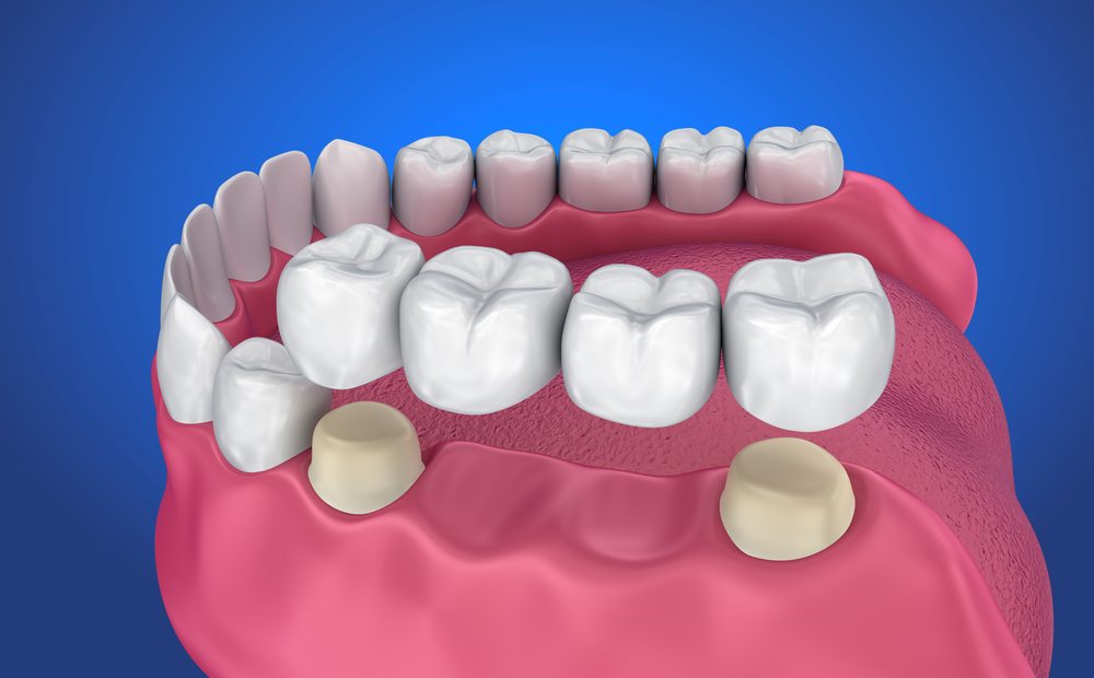 Cầu răng sứ là gì?