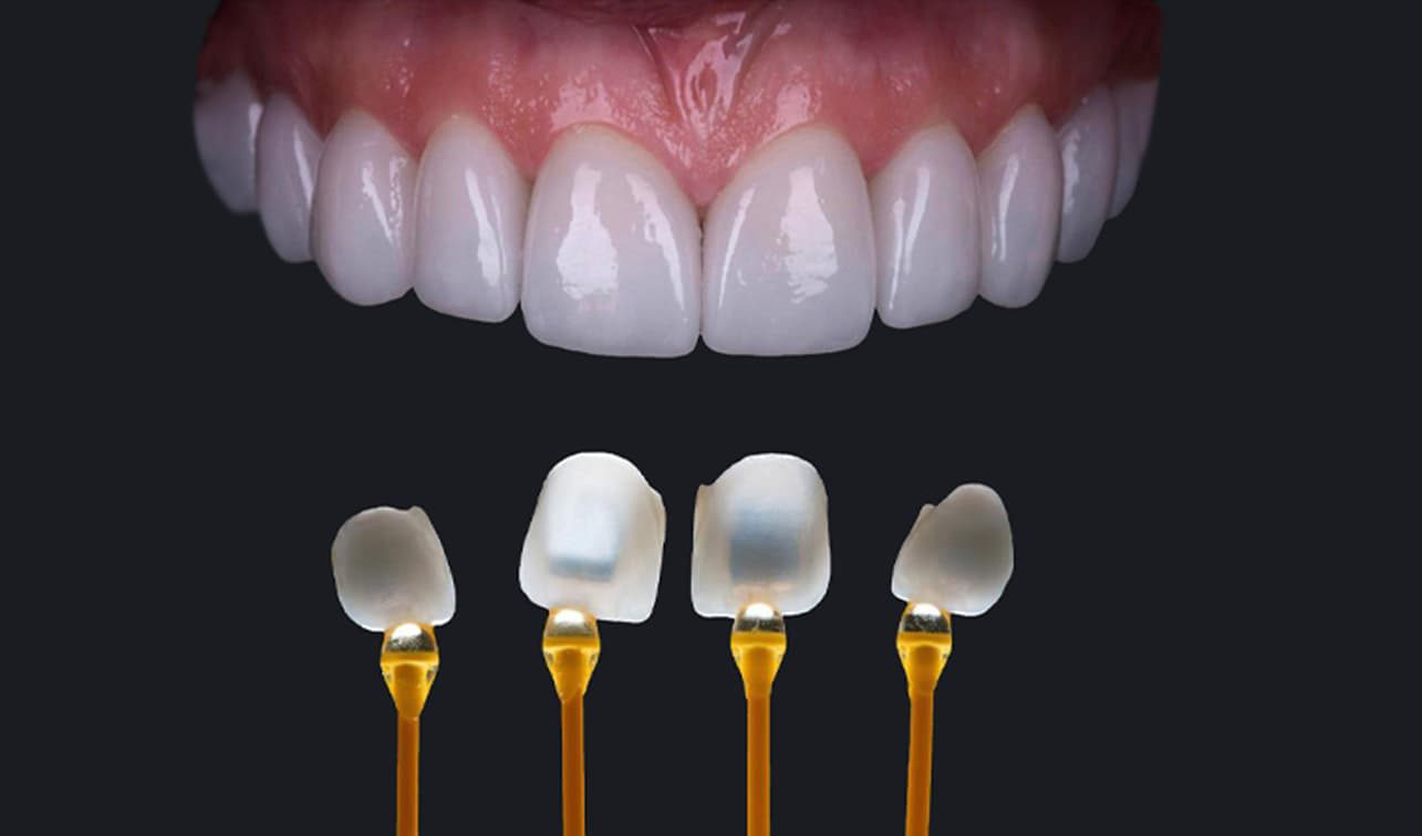 Dán sứ Veneer có tốt không?