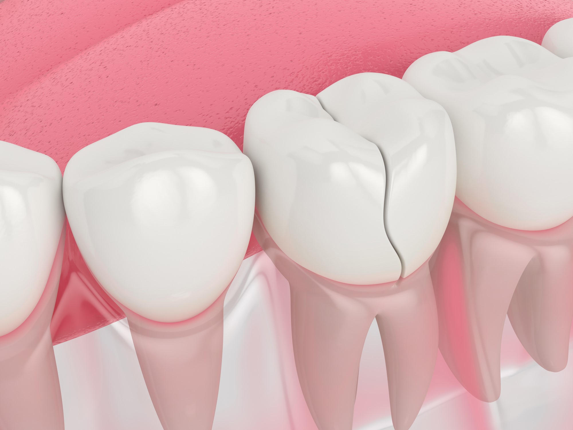 Dán sứ Veneer ít tác động răng thật