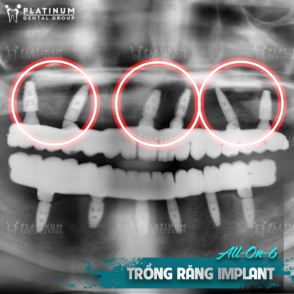 Trồng răng Implant