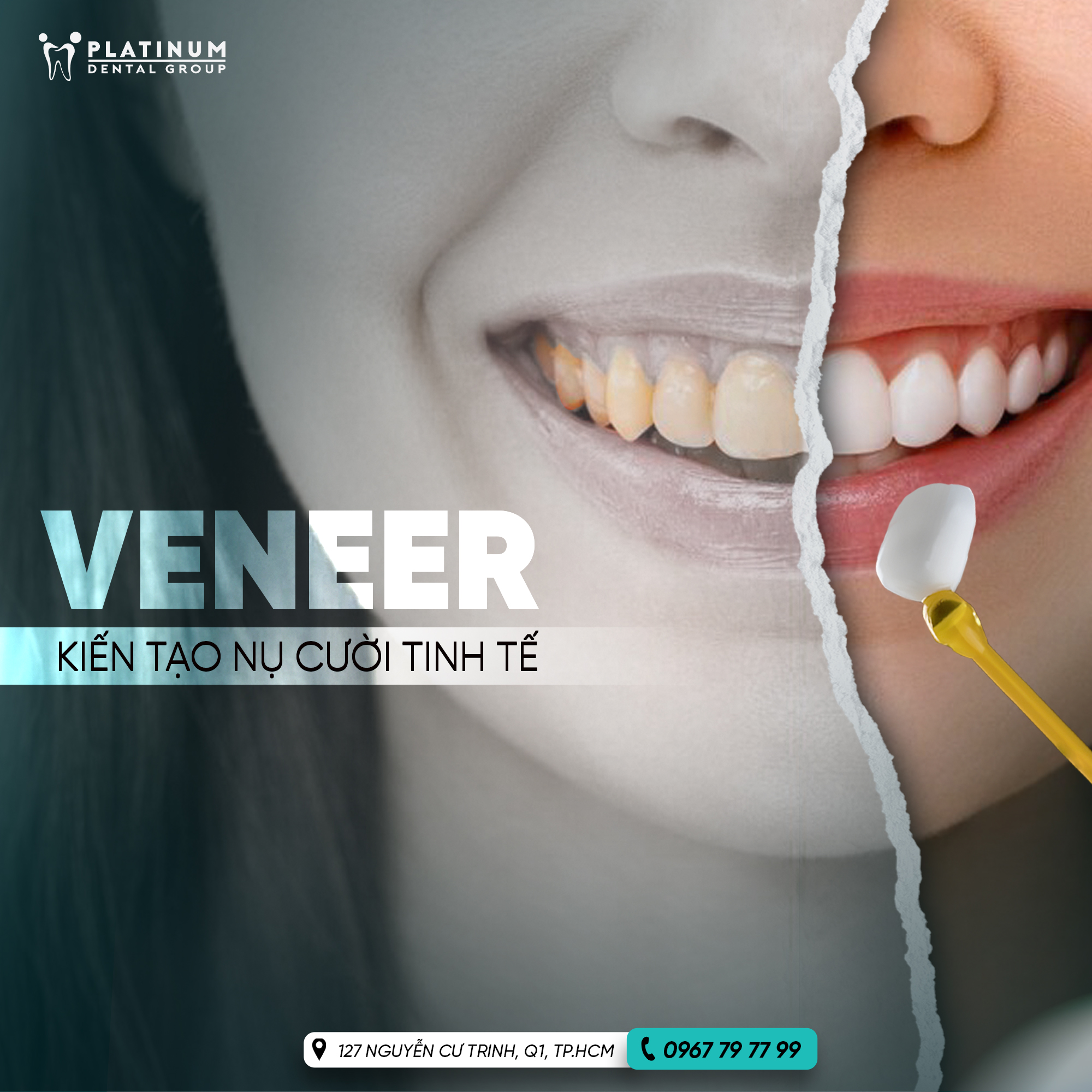 Dán sứ Veneer