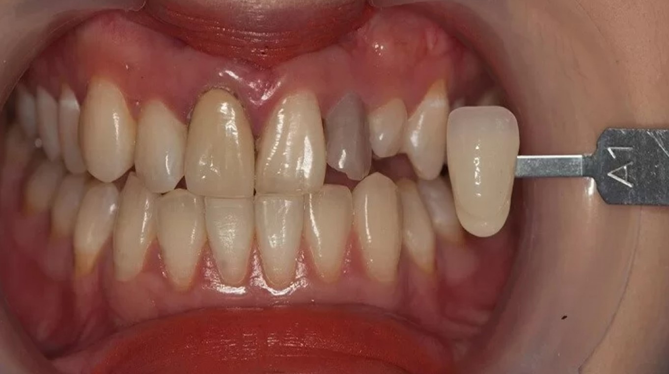 Có nên bọc răng sứ giá rẻ không?