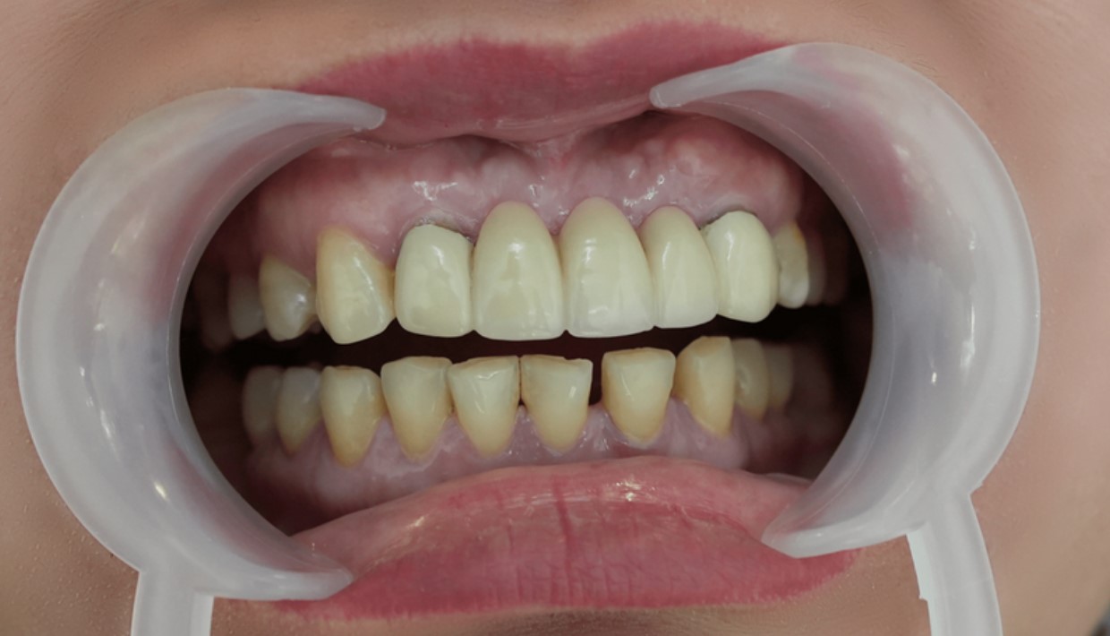 Có khe hở ở vùng tiếp giáp răng sứ và nướu
