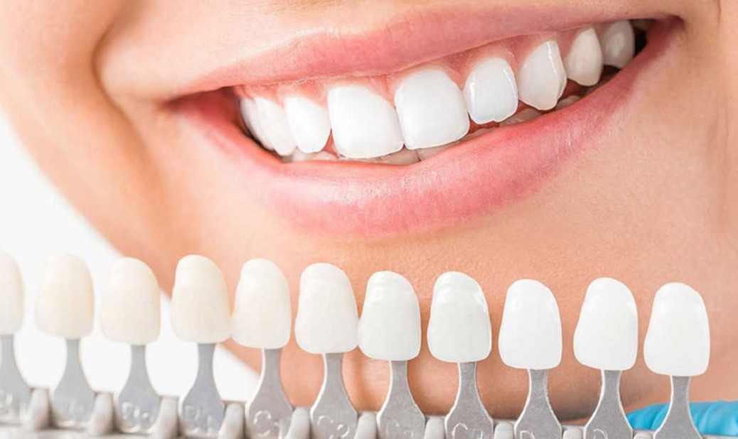 Ưu điểm của răng sứ Cercon
