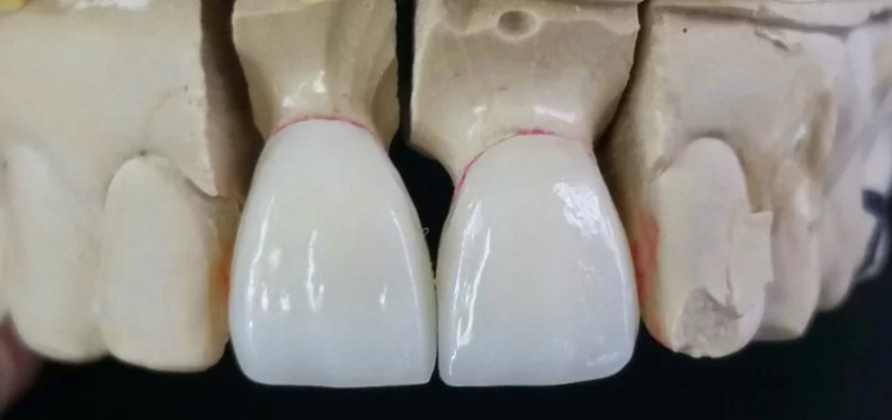 Răng sứ Emax là gì?