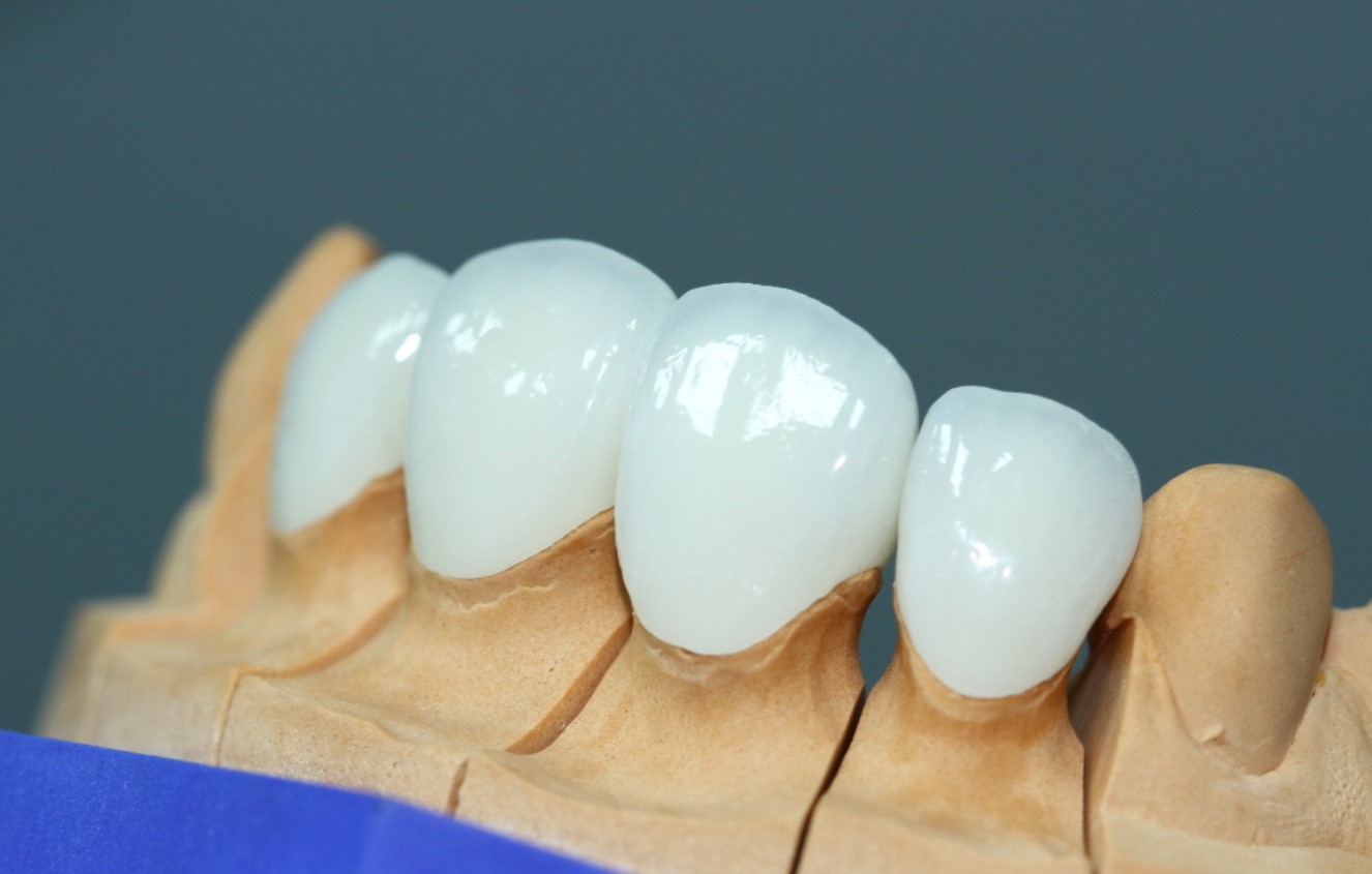 Răng toàn sứ Emax CAD