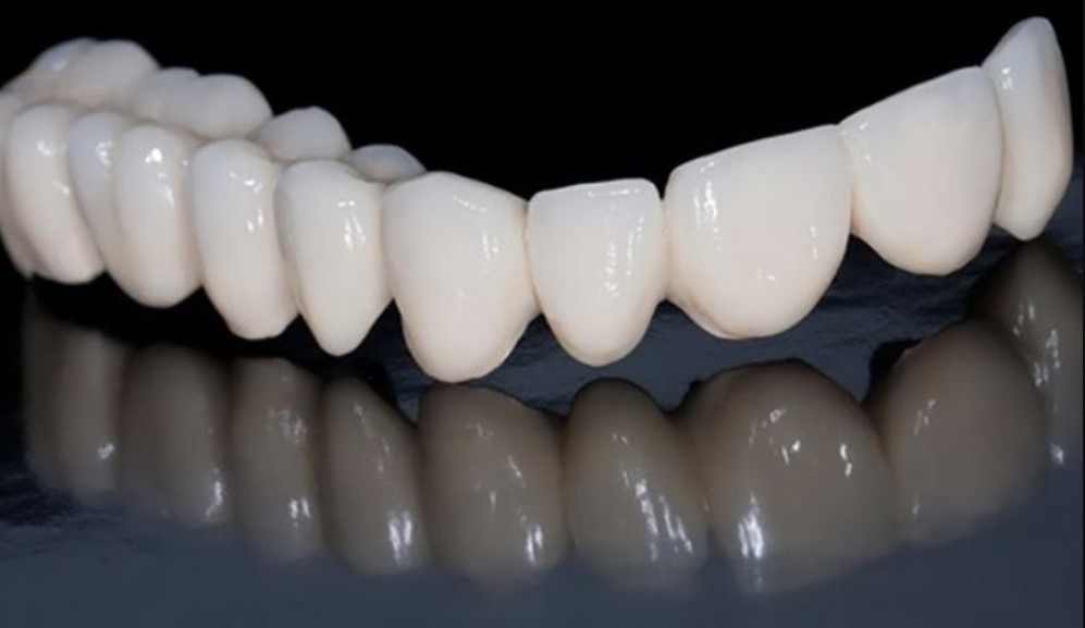Răng sứ Emax có tốt không?