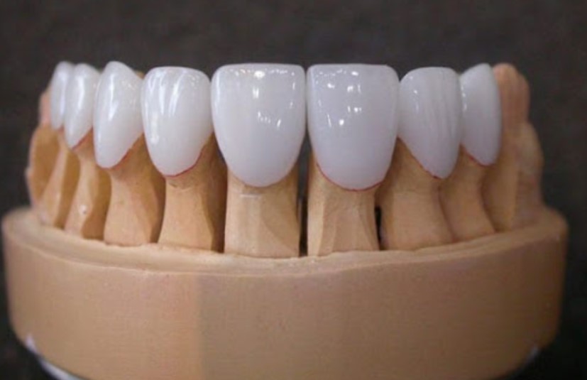 Răng sứ HT Smile có mấy loại?