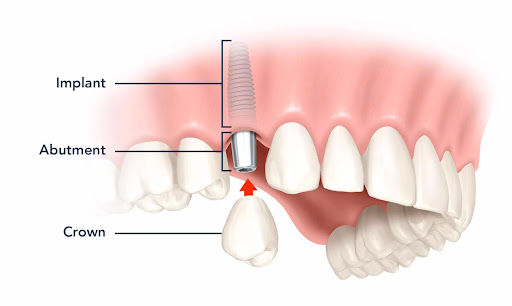 Các bước phục hình răng sứ trên Implant