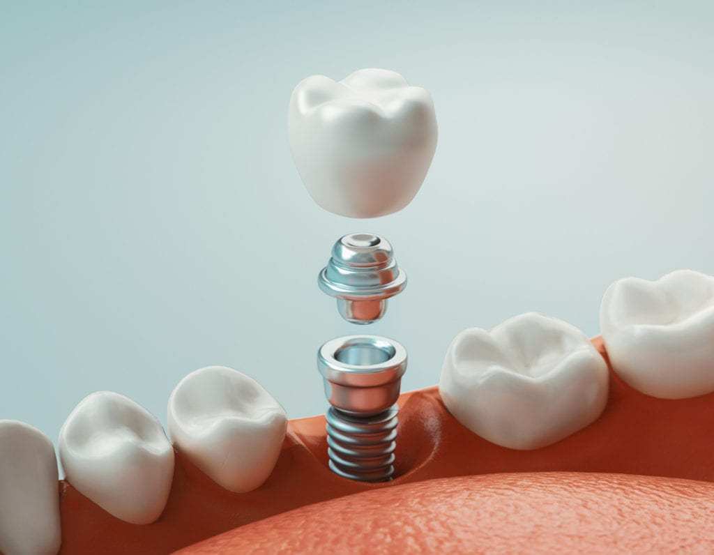 Loại răng sứ phù hợp phục hình trên Implant