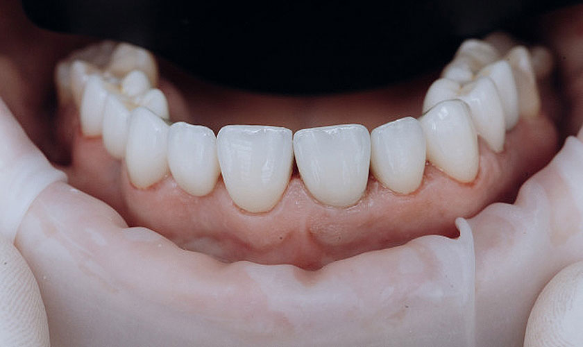 Một số trường hợp nên bọc răng sứ