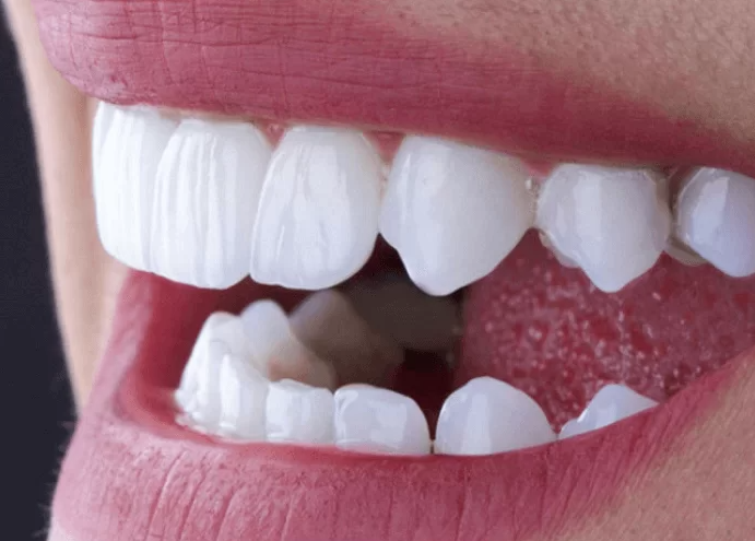 Bọc răng sứ zirconia có tốt không