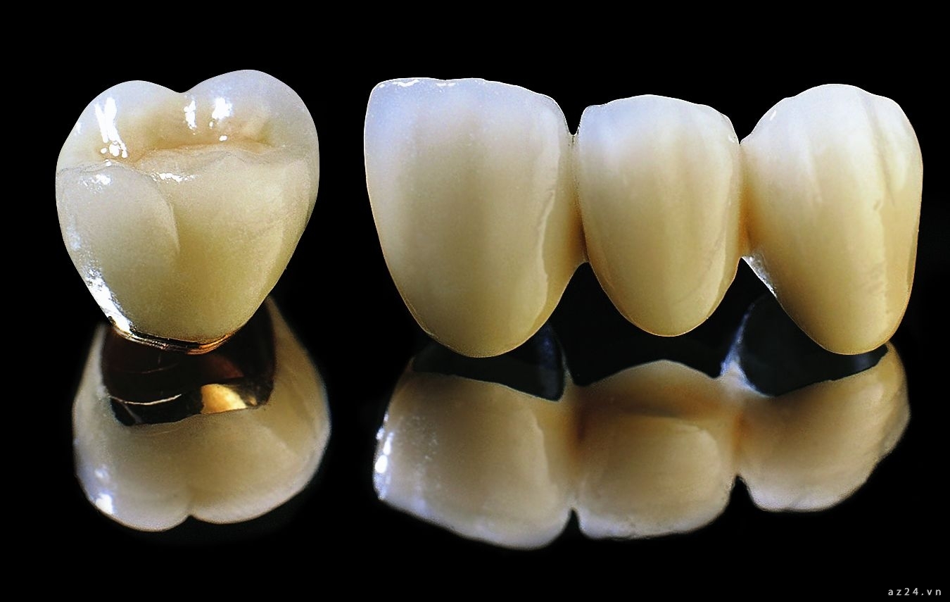 Tổng quan răng sứ Titan