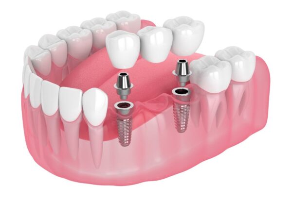 Tổng quan về cách phục hình răng sứ trên implant