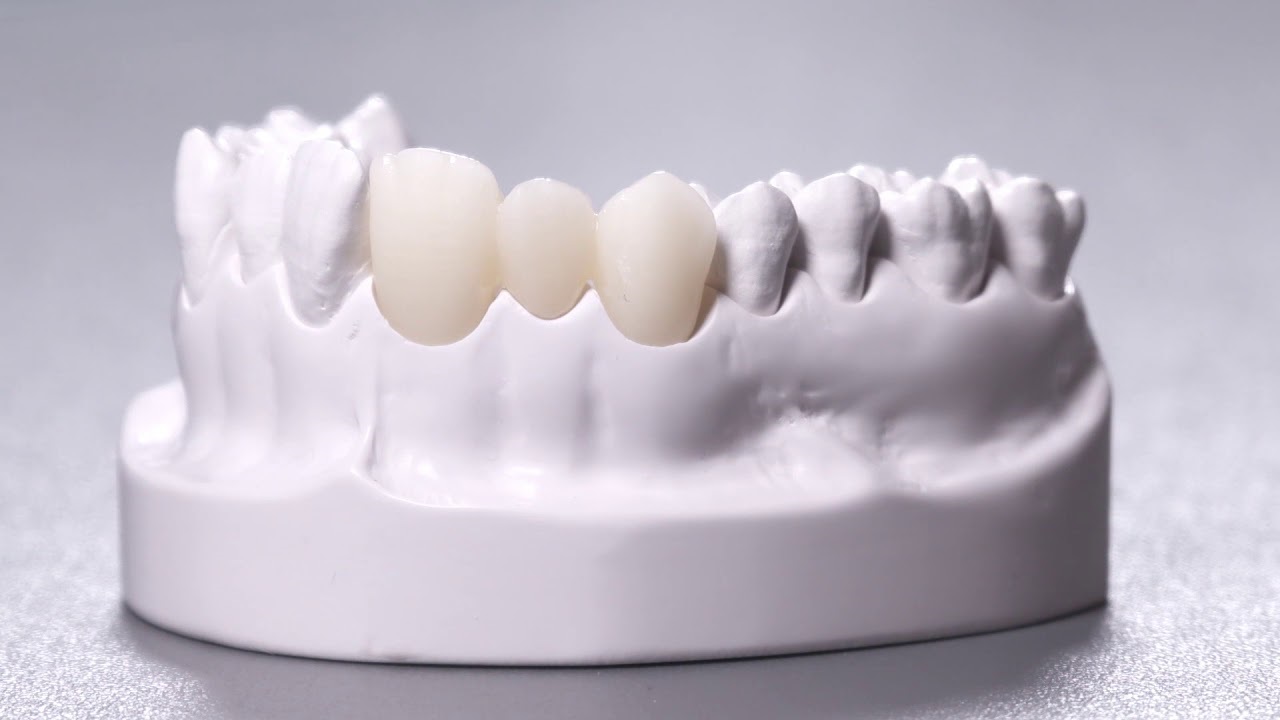 Top răng toàn sứ chất lượng